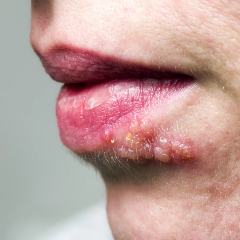 Patologia herpes en farmacia farmatrave156 en vigo
