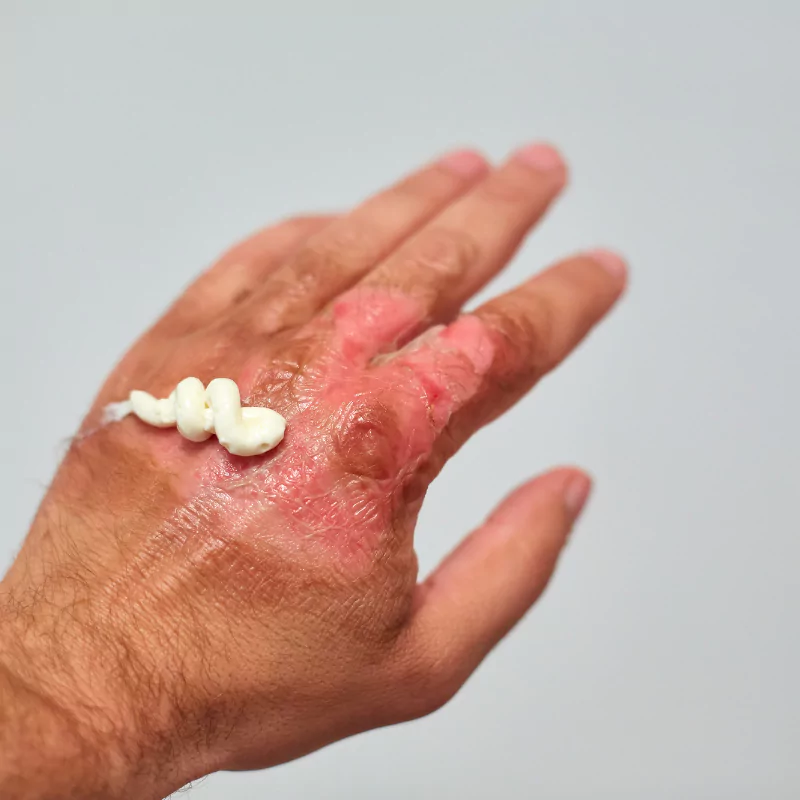 Patologia quemaduras en farmacia farmatrave156 en vigo